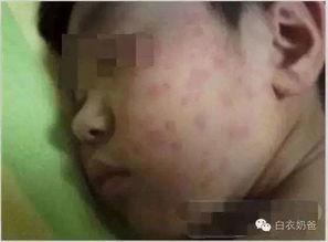 吃伏儿瓜孩子过敏,警惕孩子食用伏儿瓜引发的过敏反应